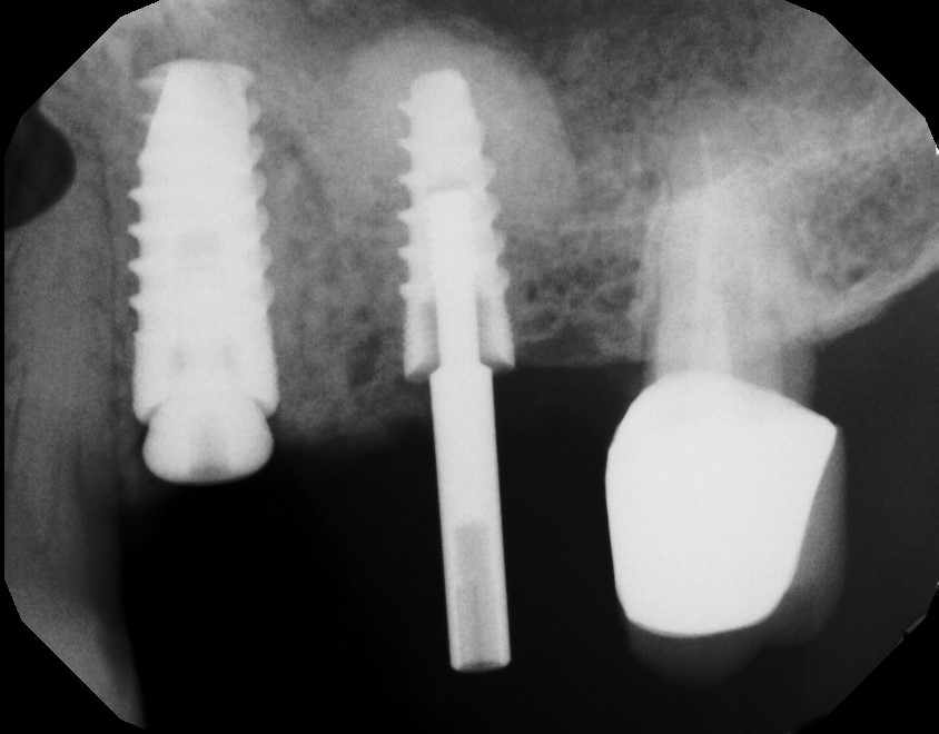 x-ray implant