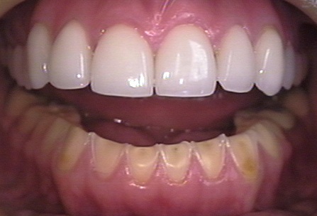 eroded teeth