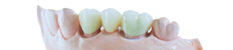 Dental bridge 3 teeth medically illustration treatment