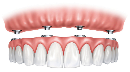 Dental implantation process with All-on-4® (Same-day teeth)