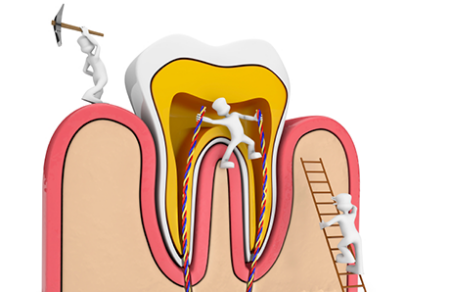 Dental root canal treatment