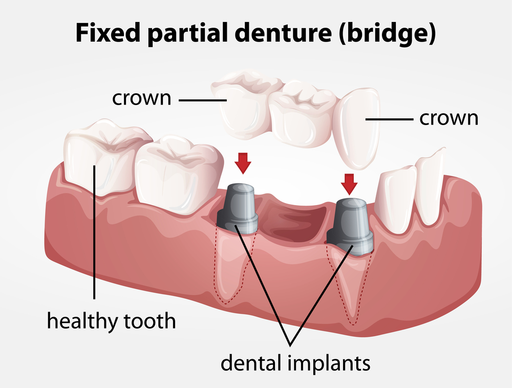 Illustration of a Fixed partial denture bridge