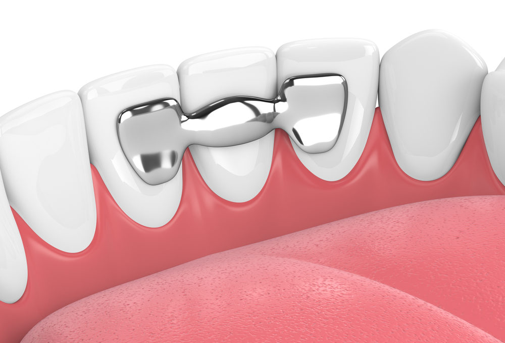 3d render of jaw with teeth and maryland bridge in gums isolated over white background