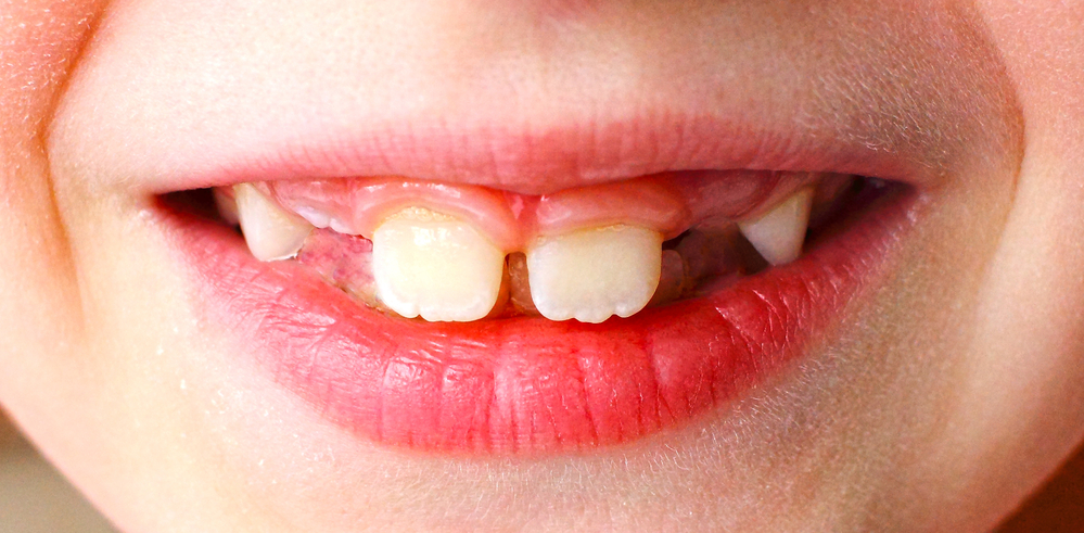 Closeup of a child's smile with missing teeth, for the development of teeth medicine
