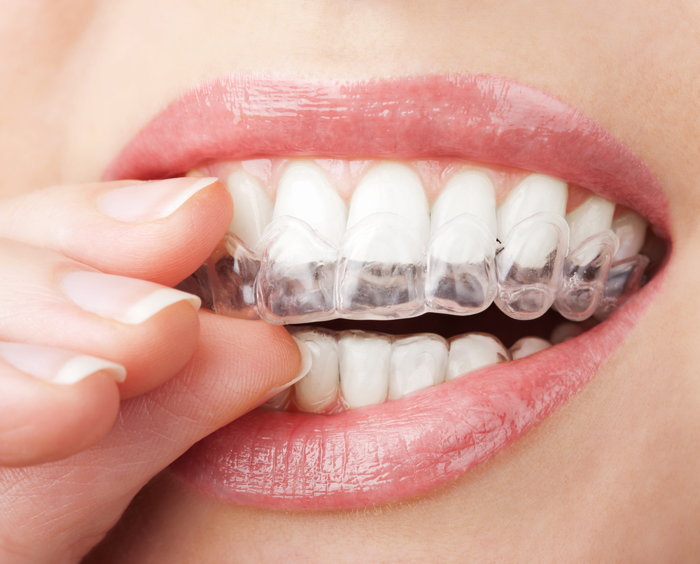 woman smiling with clear aligners trays