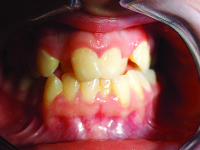Orthodontic treatment for cross bite Flora before