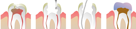 Graphic of root canal treatments