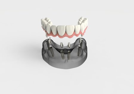 Graphic of implant supported denture