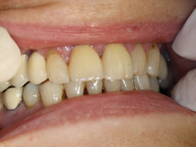 Dental implants treatment Irene after