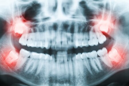 Panoramic x-ray wisdom tooth
