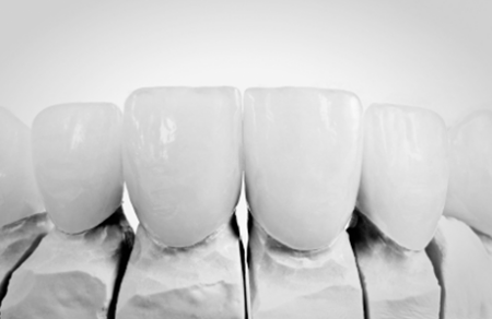 Porcelain teeth veneers