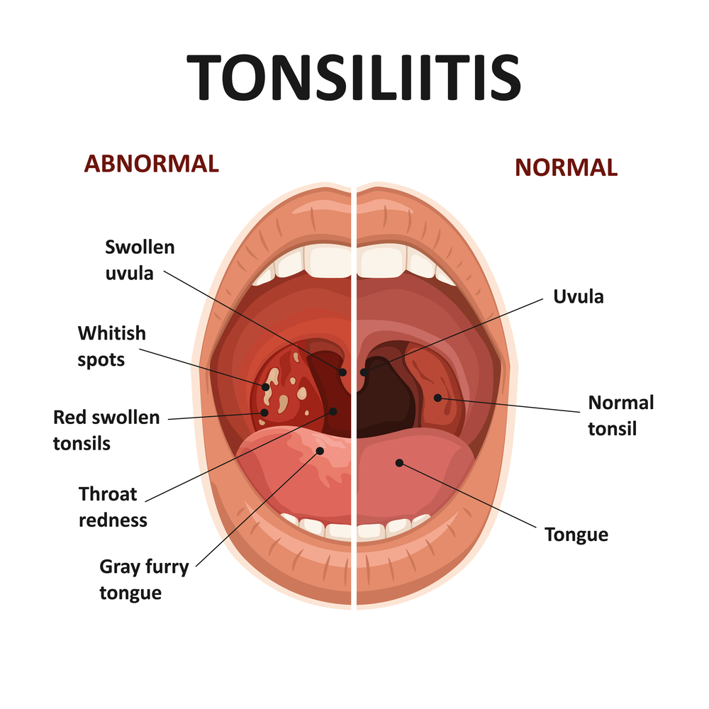tonsil crypt anatomy