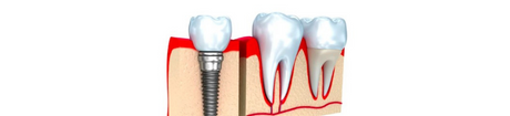 dental crown tooth replacement london