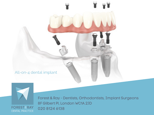 All-on-4 Dentures in Central London, Forest & Ray - Dentists, Orthodontists,  Implant Surgeons