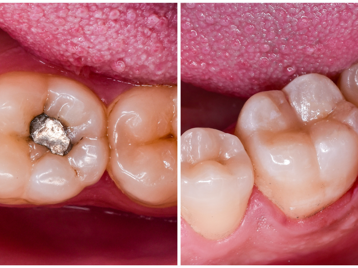 Amalgam fillings vs sale composite