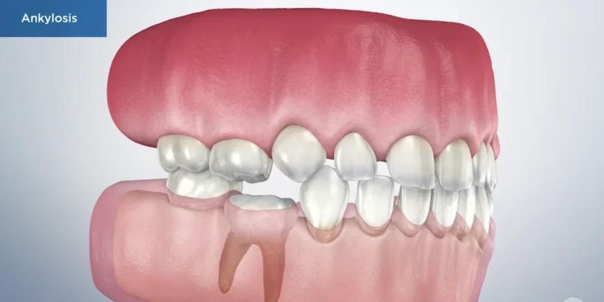 ankylosis
