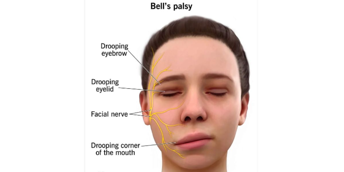 Bell's palsy - Forest & Ray - Dentists, Orthodontists, Implant Surgeons