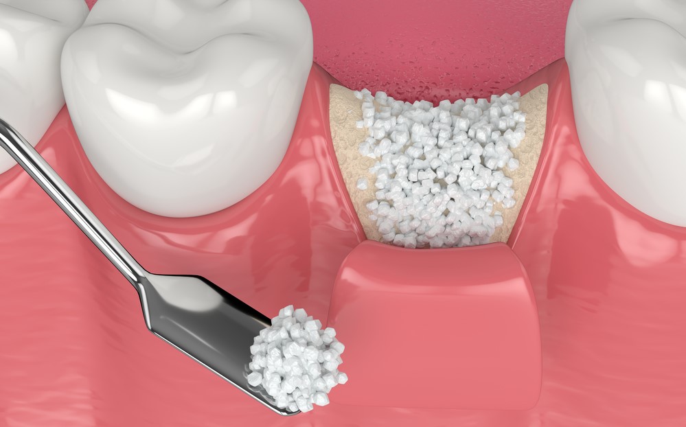 3D render of dental bone grafting with bone biomaterial application over white background. Jaw bone augmentation concept.