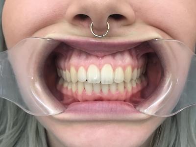 Orthodontic Treatment Crowding and Overbite - Alexandra After