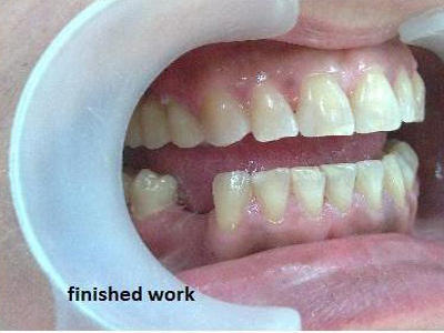 Teeth replaced dental implants Agapi after