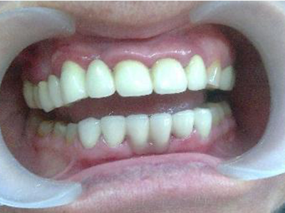 Replaced teeth porcelain bridge Maria after