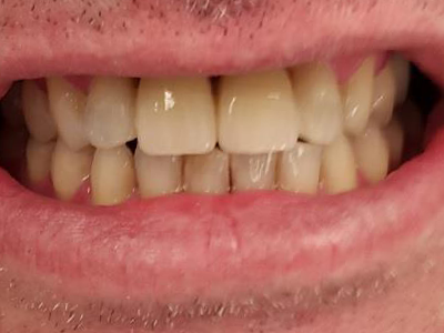Front teeth replaced with maryland bridge Peter after