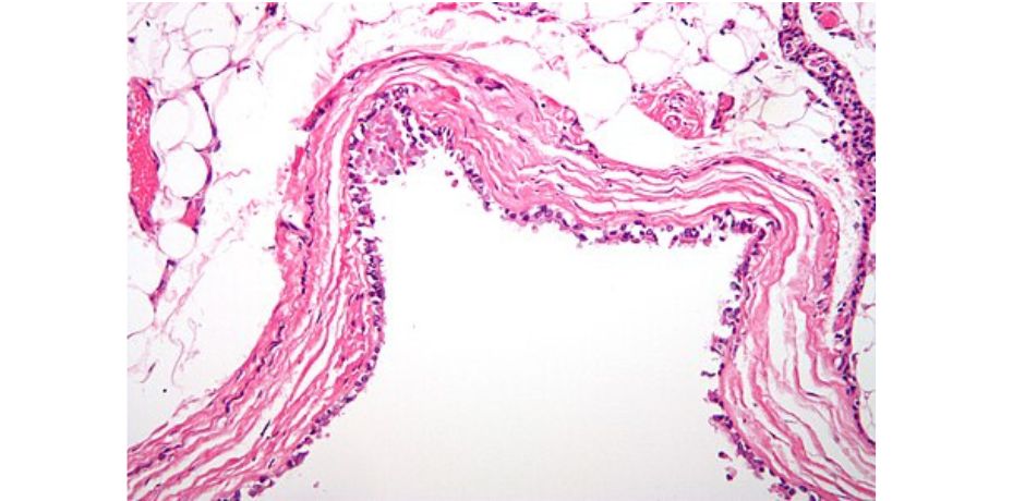 cyst