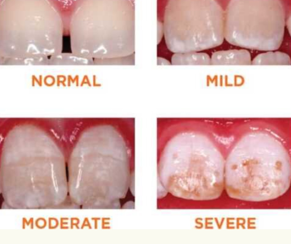 Dental Enamel Hypoplasia