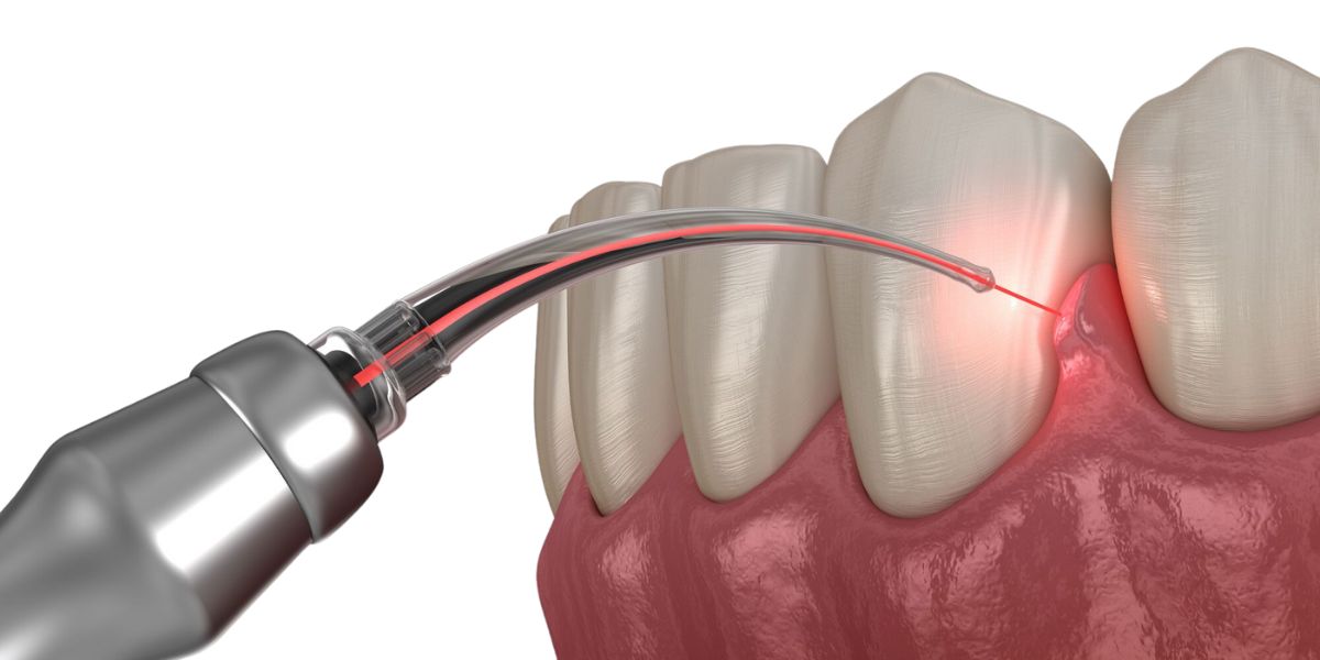 Dental fiberotomy