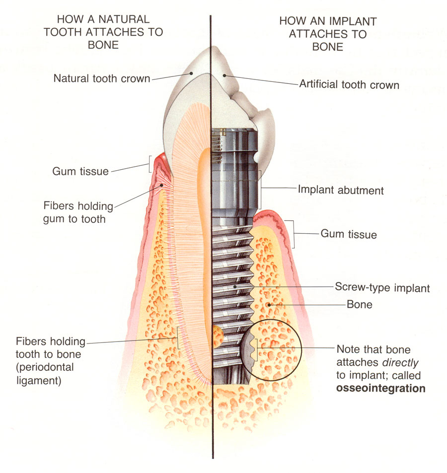 Advantages of Anatomical Implants - Berkeley Square Medical - Central London