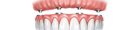 Dental implantation process with All-on-4® (Same-day teeth) 2