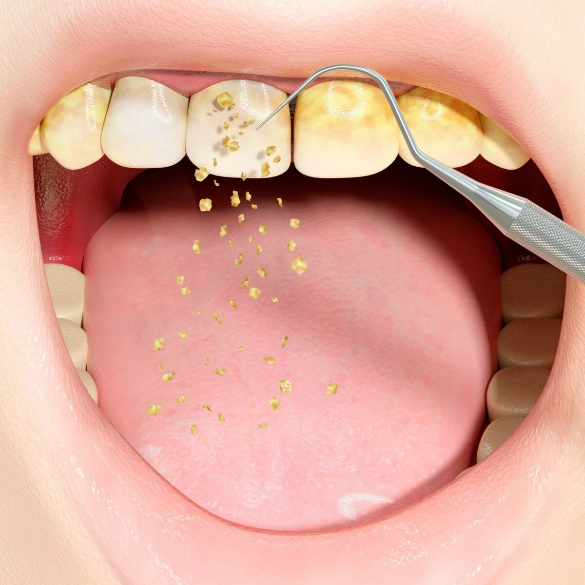 Mouth plaque discount