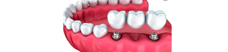Dental Bridge Tooth Replacement London