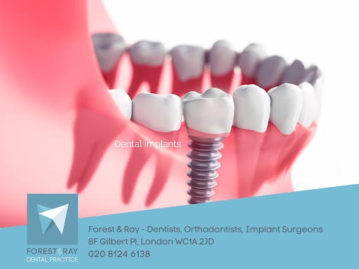 Chipped Teeth repair in London Ontario - London Ontario Dental Clinic