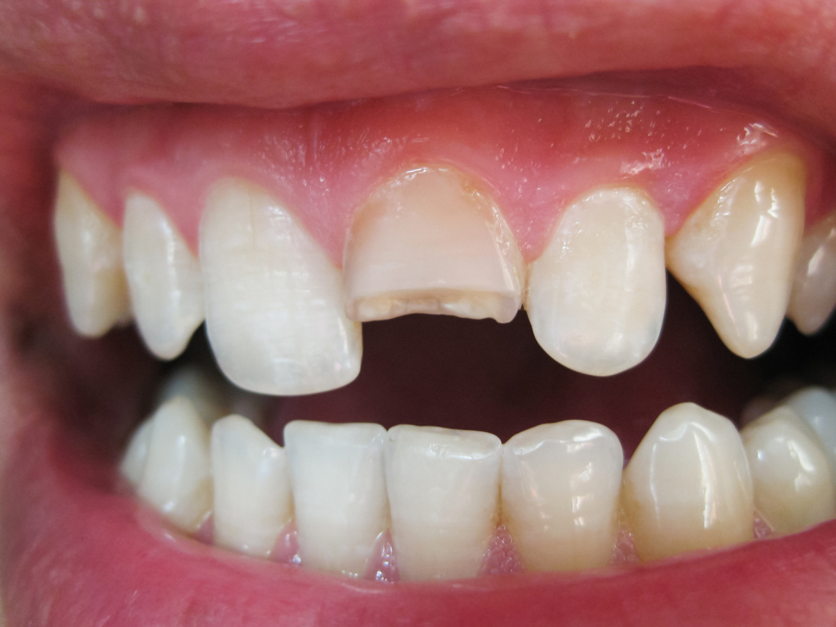 BROKEN TEETH: TRAUMA AND TREATMENT - Serene Dental