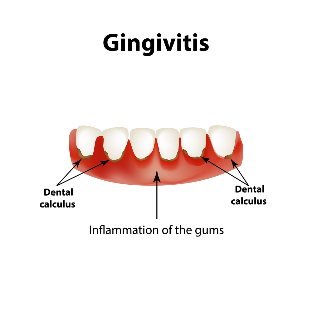 Gingivitis Forest And Ray Dentists Orthodontists Implant Surgeons