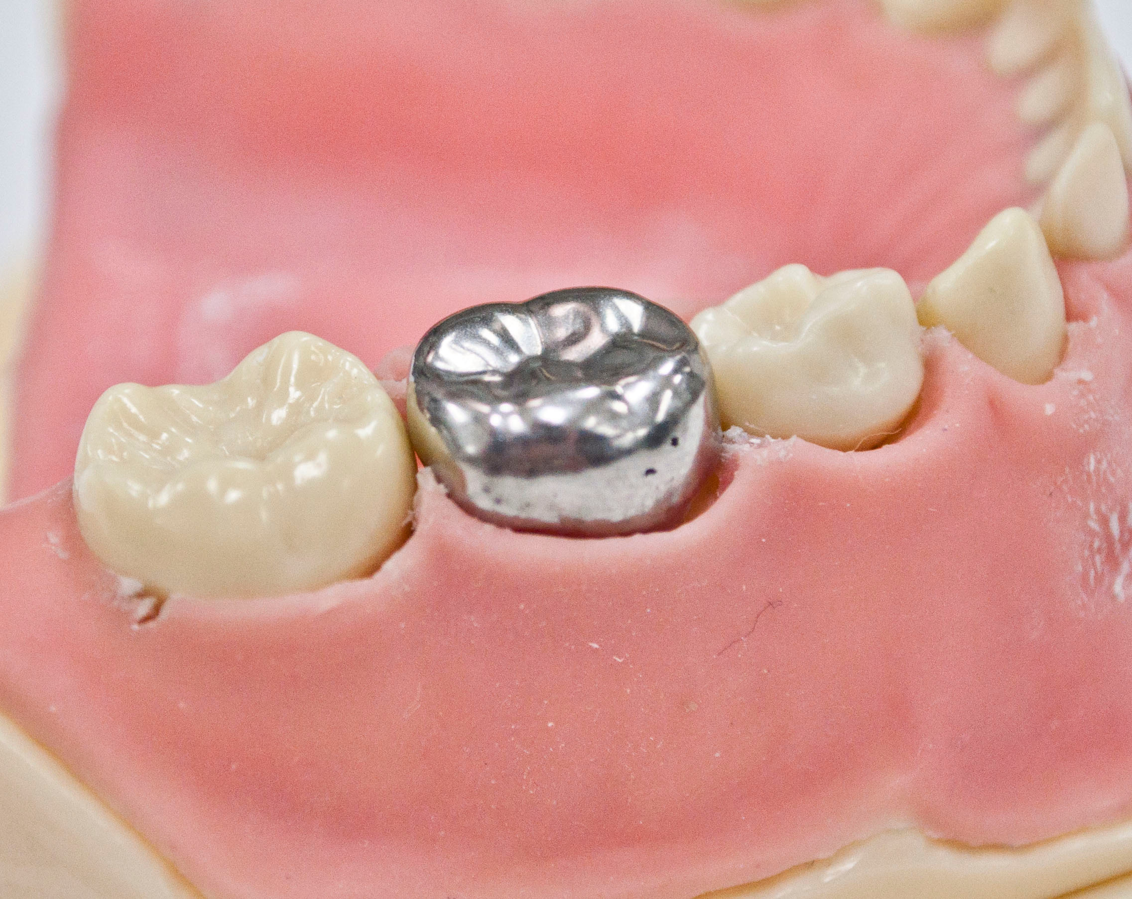 Hall Technique Stainless Steel Crown placed on a Tooth
