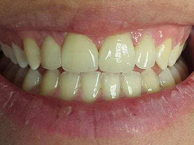 Teeth restored by Cosmetic Dentist in London