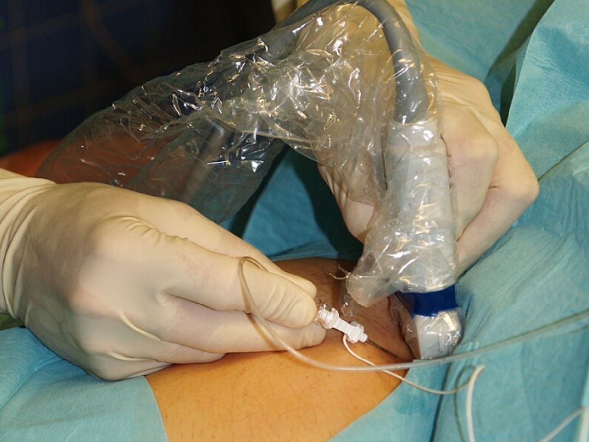 Nerve block