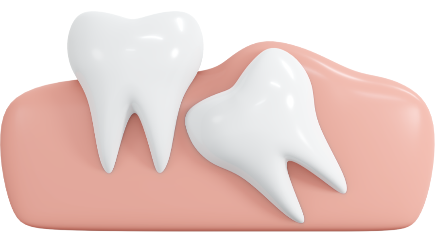 pericoronitis infection