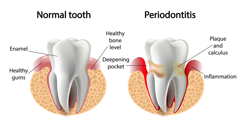 Periodontal disease Forest Ray Dentists Orthodontists