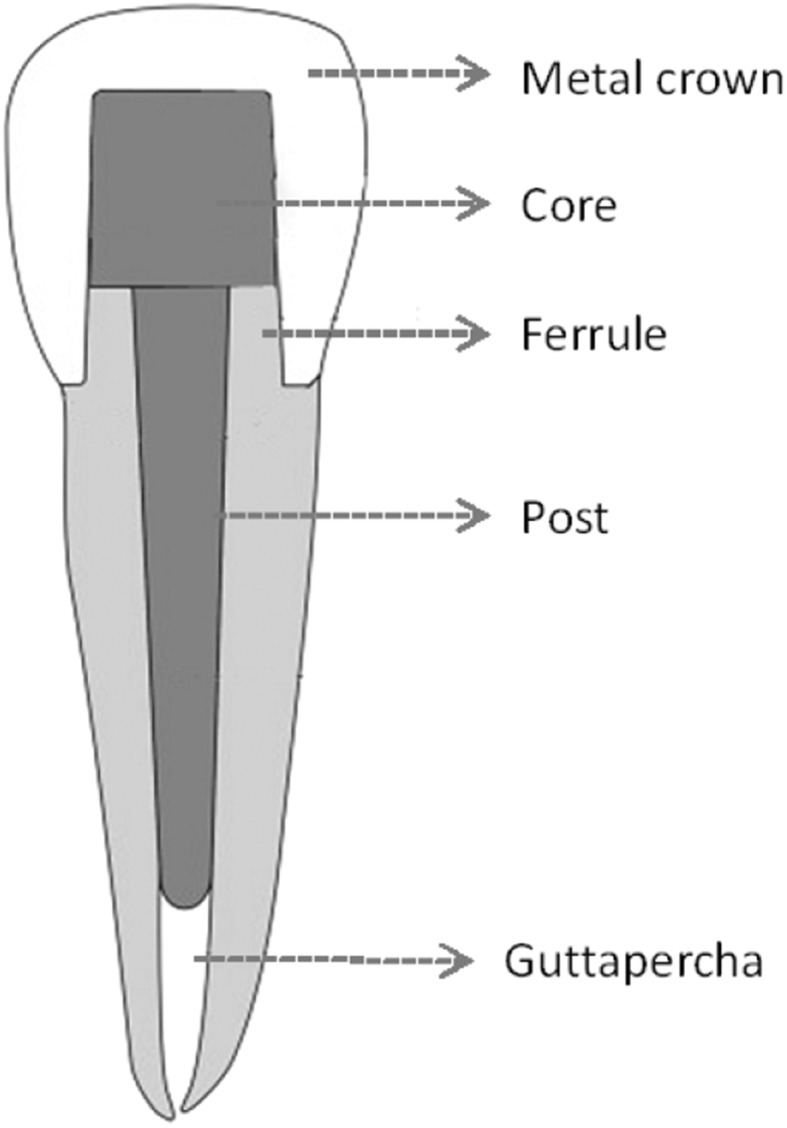 Diagram of dental tooth structure (post and core) with labeled parts