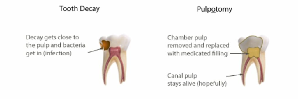 Pulpotomy - Forest & Ray - Dentists, Orthodontists, Implant Surgeons