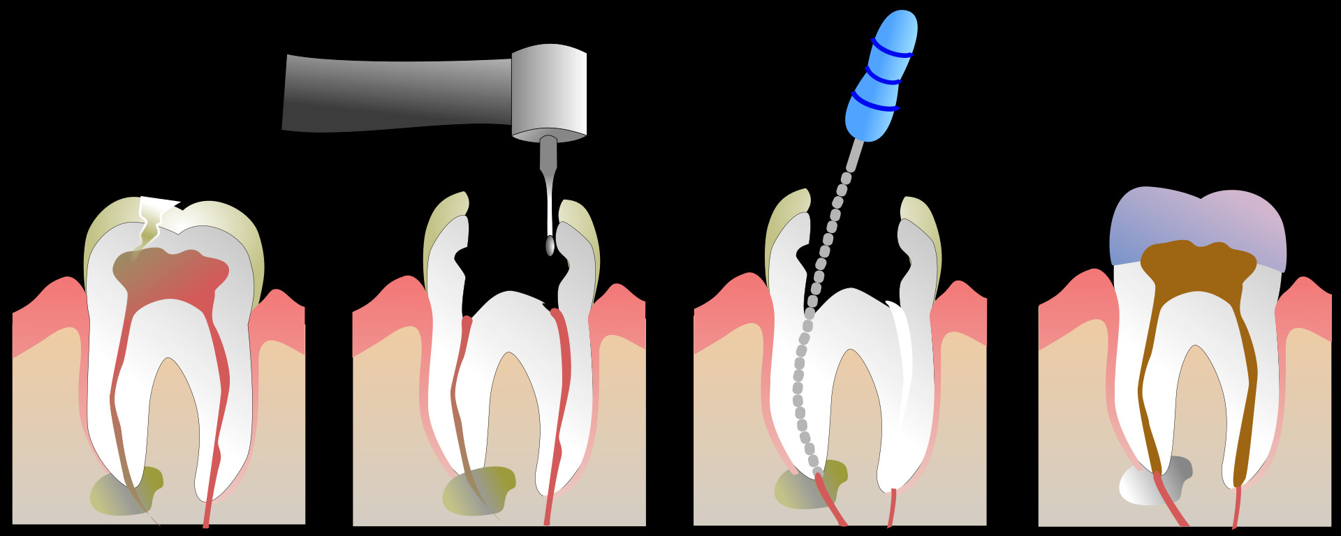 Временное пломбирование корневых. Апикальный периодонтит зуба 2.4. Мышьяковистый периодонтит.