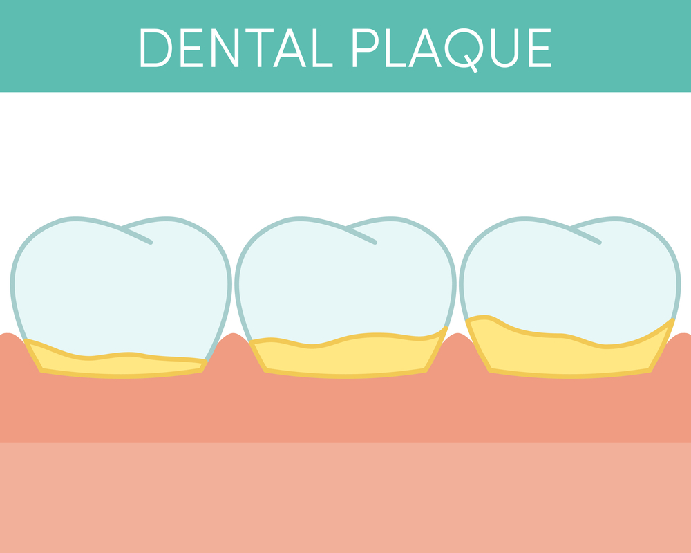 Dental plaque concept. Vector illustration of human molar teeth with oral biofilm