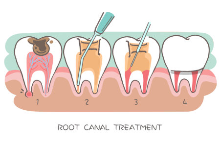 tooth with root canal treatment on the hwite background