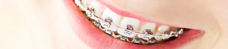 Traditional dental braces