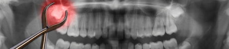Wisdom tooth panoramic X-ray